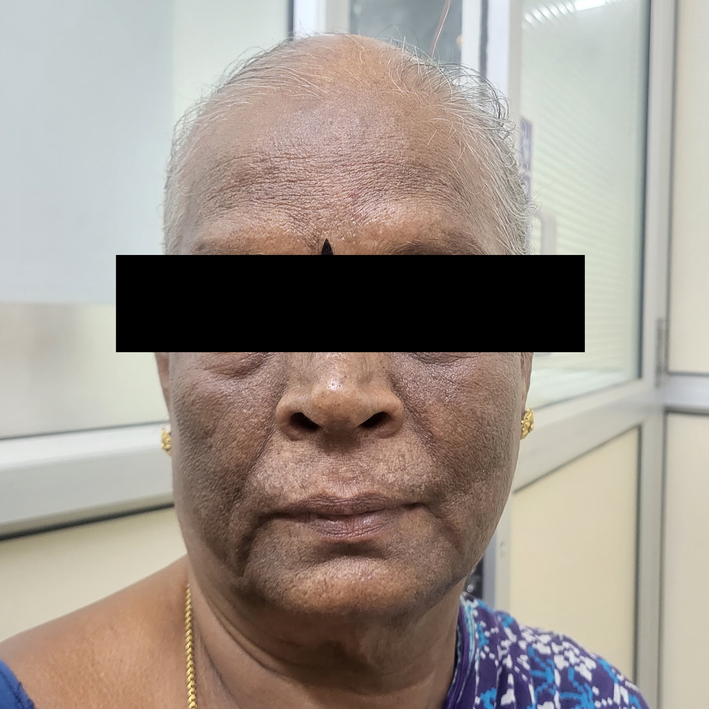 Melasma before treatment
