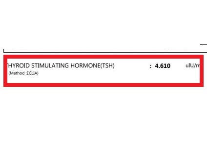 Thyroid after treatment