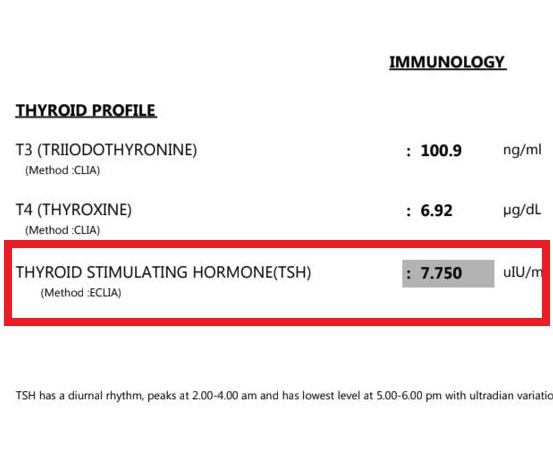 Thyroid before treatment